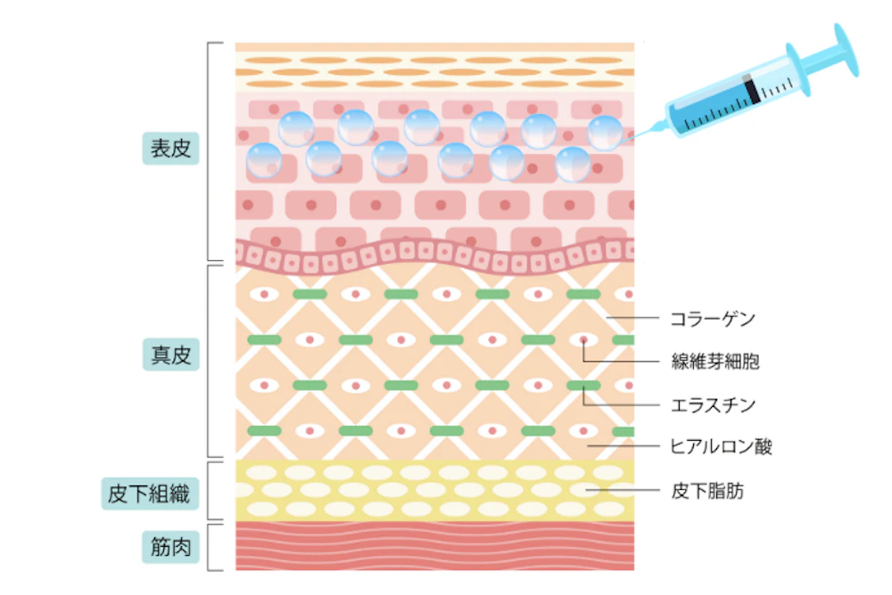 マイクロボトックス注射